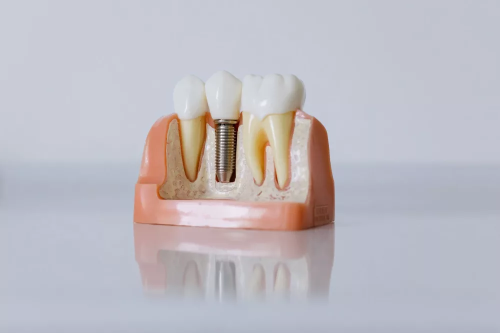 Unpacking 'Cheap Dental Implants': What You Really Need to Know